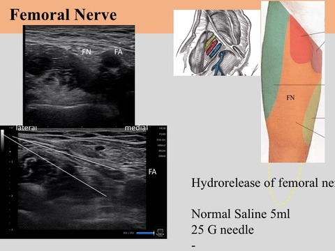 超音波ガイド下神経ブロックによる疼痛マネージメント : スポーツ整形