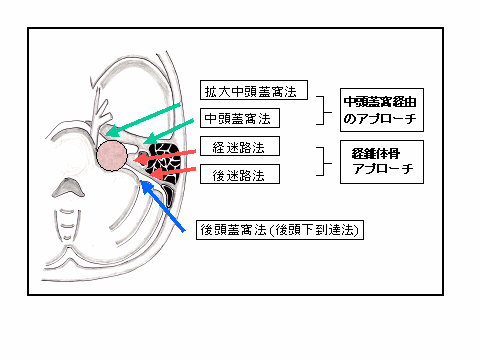 聴神経腫瘍の手術アプローチの使い分け
