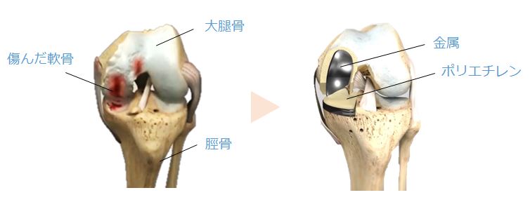 人工膝関節単顆置換術 | あんしん病院