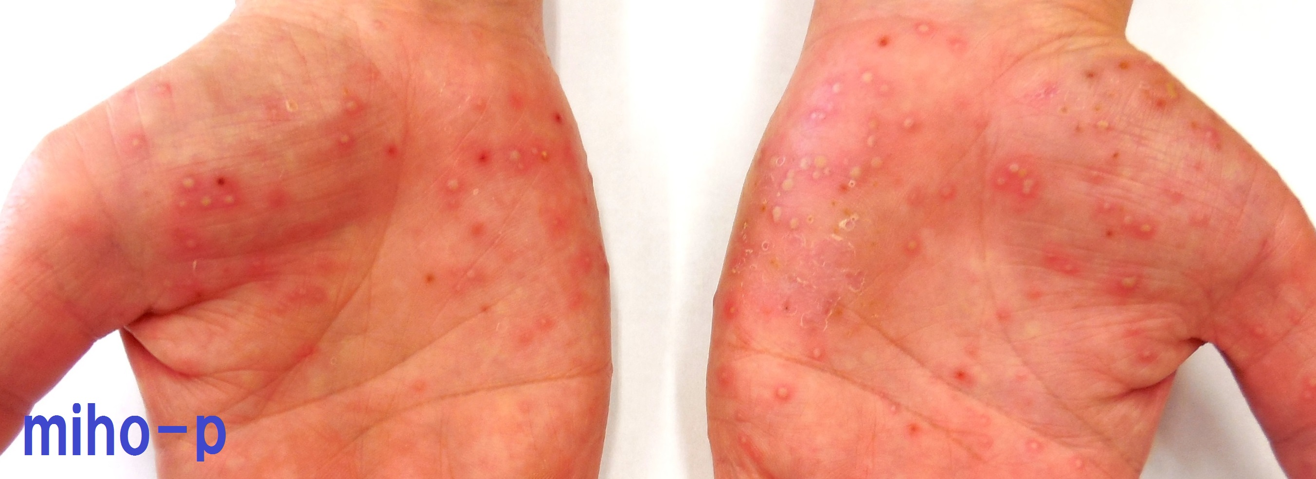 長年悩まれた掌蹠膿疱症(しょうせきのうほうしょう)の改善例