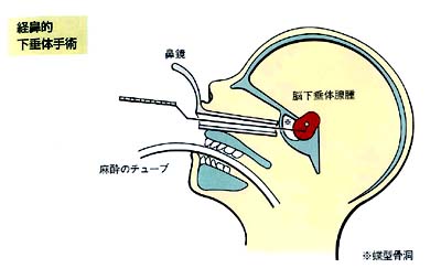 下垂体腫瘍｜日本医科大学武蔵小杉病院
