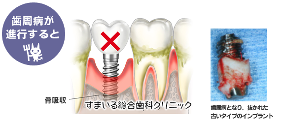 インプラントと歯周病の関係｜インプラント 愛媛【すまいる総合歯科