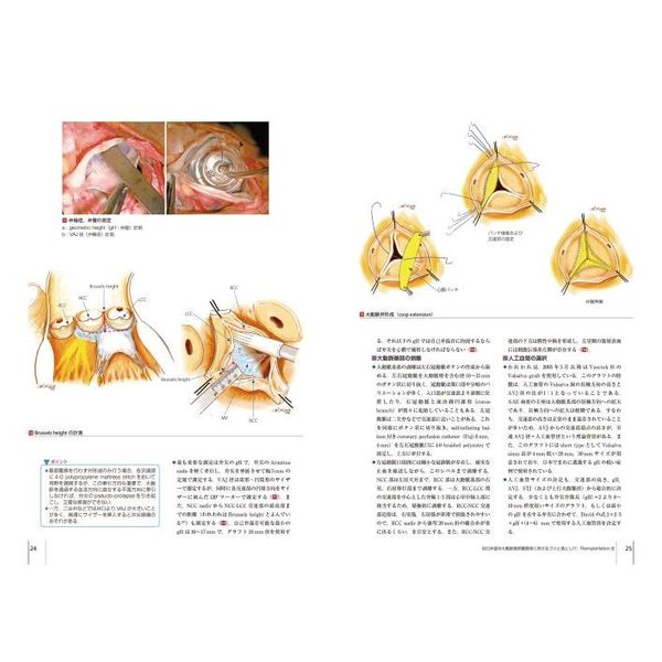 心臓血管外科手術エクセレンス 手術画と動画で伝える 4 大動脈疾患の