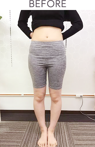 O脚・X脚矯正 | 広島市南区で口コミ上位 あさひ整骨院