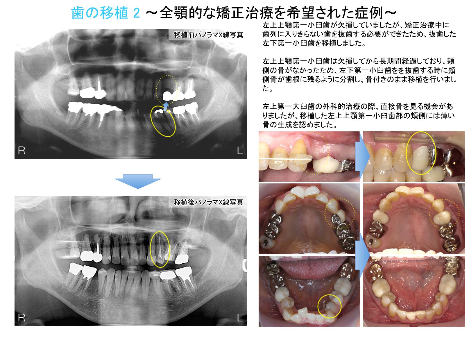 歯の移植治療 | タカシマデンタルクリニック
