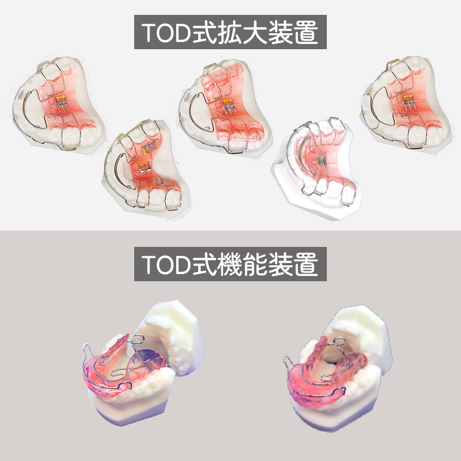 子供の矯正装置 | トリス矯正デンタルクリニック｜東松山の歯科クリニック