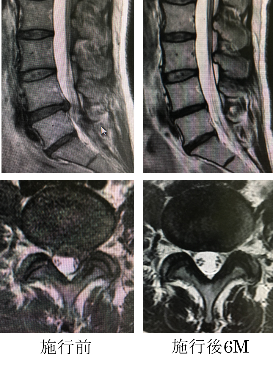 腰椎椎間板ヘルニア - 東京科学大学 整形外科