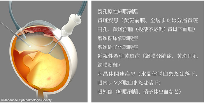 網膜硝子体手術SOS トラブルとその対策　RETINAの会 Amazon.co.jp: 網膜硝子体手術SOS―トラブルとその対策 : RETINA