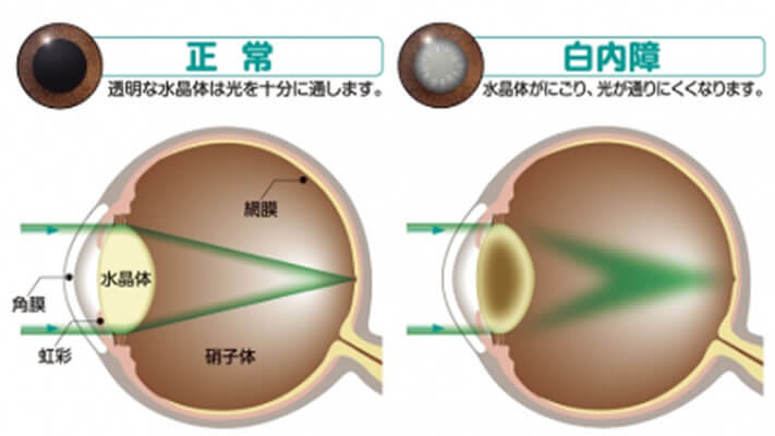 白内障治療～日帰り手術 | 診療案内 | うえだ眼科｜087-870-8181｜香川