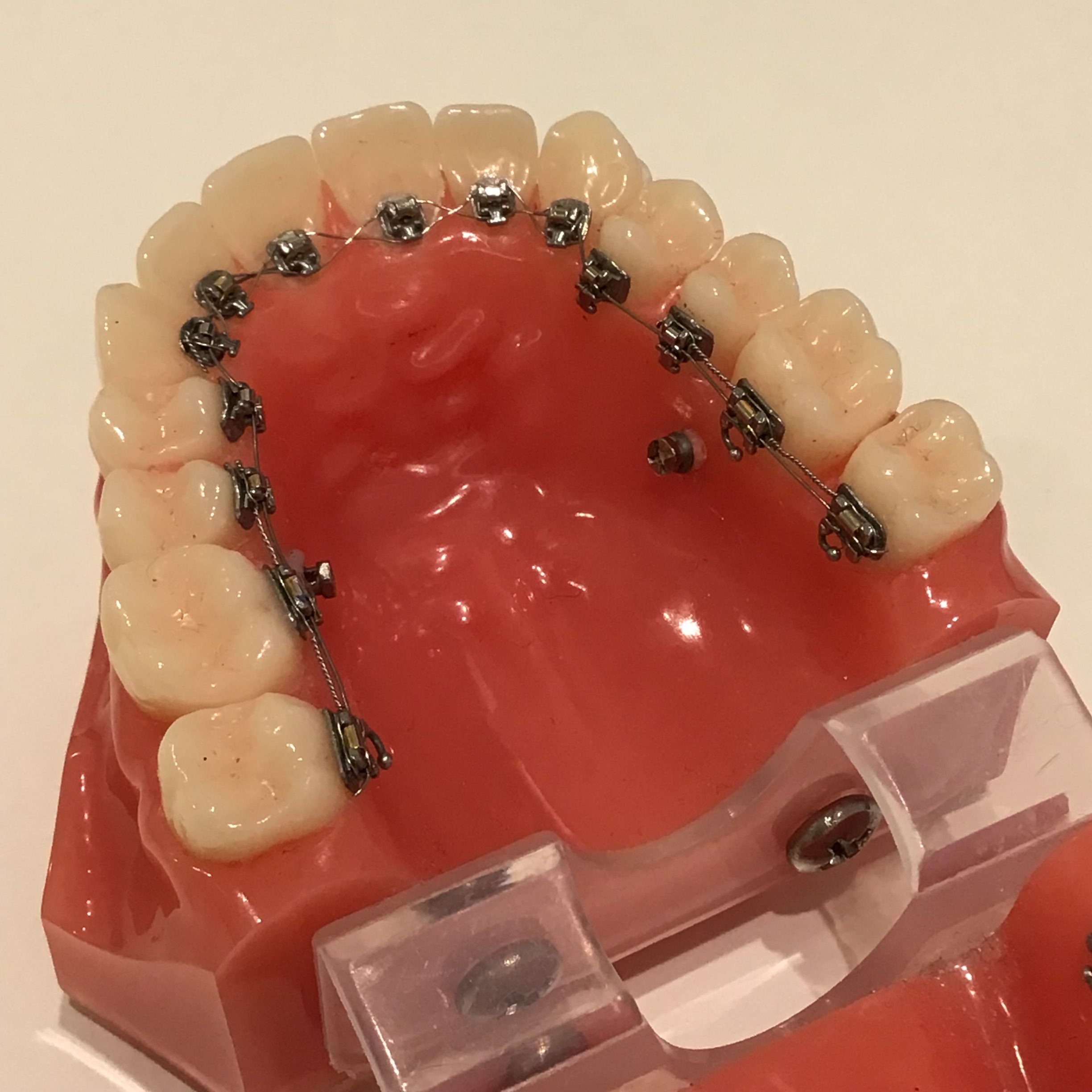 歯科矯正用アンカースクリューとは？どこに 打つの？いつまで付けるの