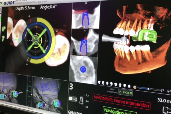 X-Guide（Xガイド） | 和光市で受けるインプラント｜『インプラント