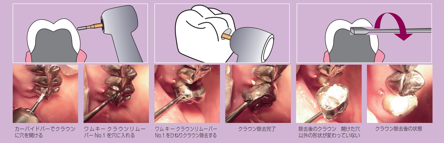 商品情報｜医療従事者向けページ｜歯科器材のクロスフィールド