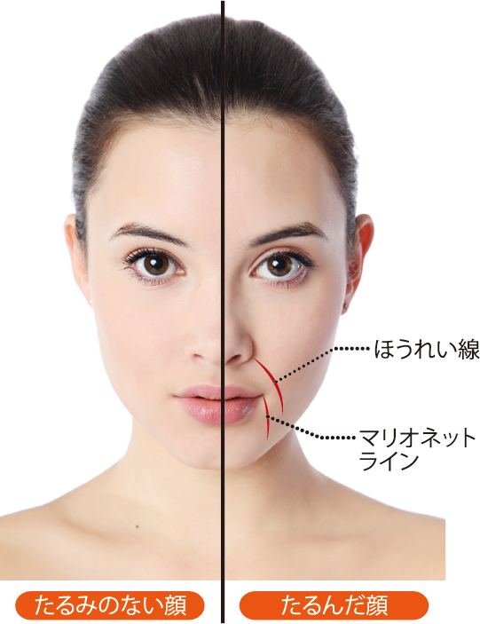 ほうれい線・マリオネットライン | 麻布皮フ科クリニック
