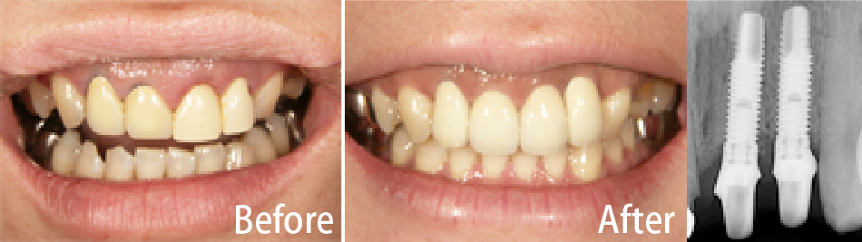 インプラント審美修復｜たかむら歯科・小児歯科武