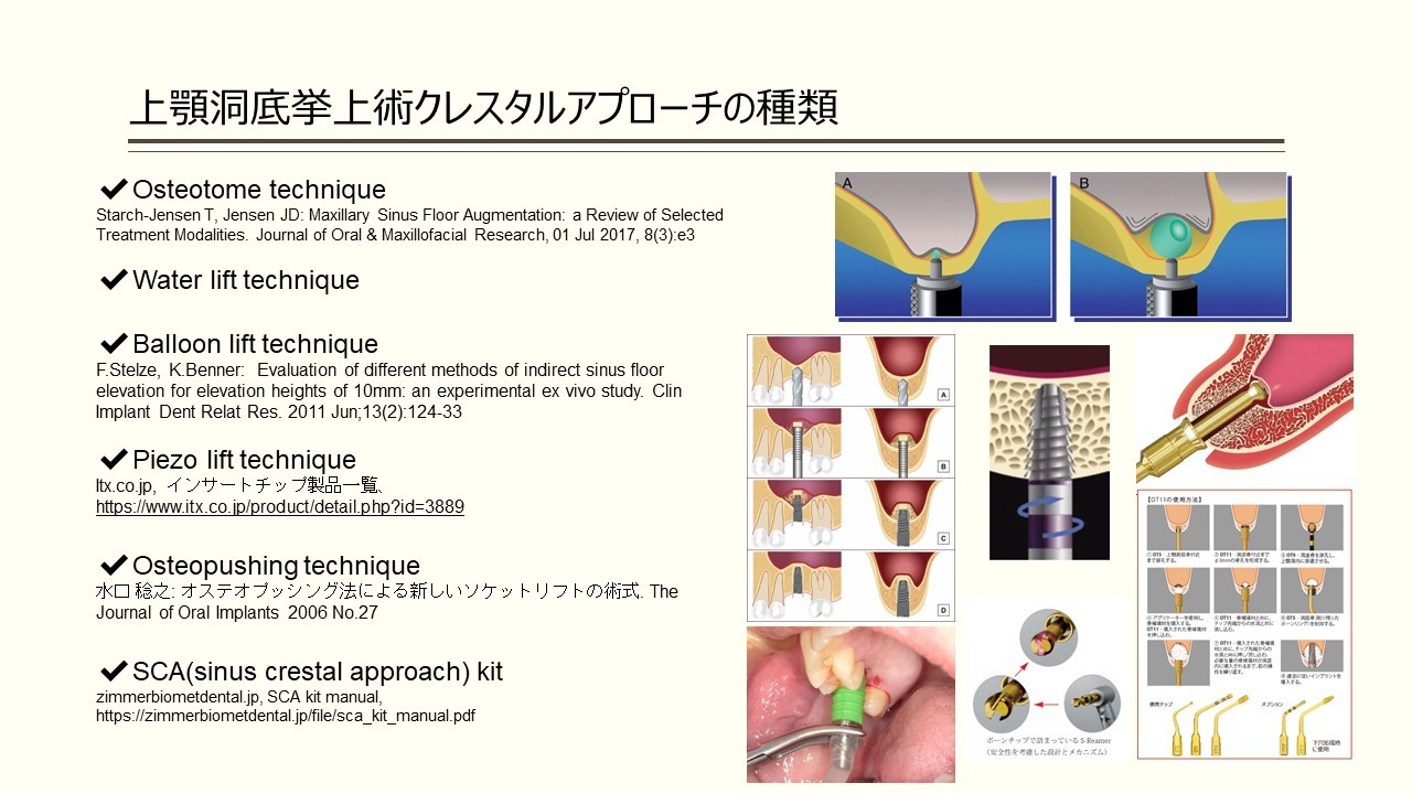 上顎洞底挙上術に関するQ&A上顎洞底挙上術に関するQ&A - 新谷悟の歯科