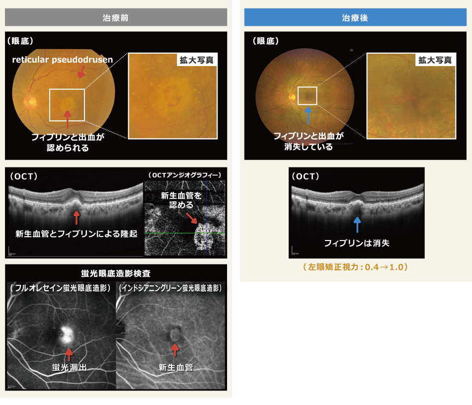 加齢黄斑変性｜倉敷成人病センター アイセンター