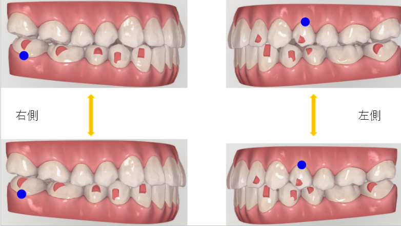 治療経過「追加アライナーへ」 | 千葉県柏市で歯列矯正なら柏KT矯正歯科
