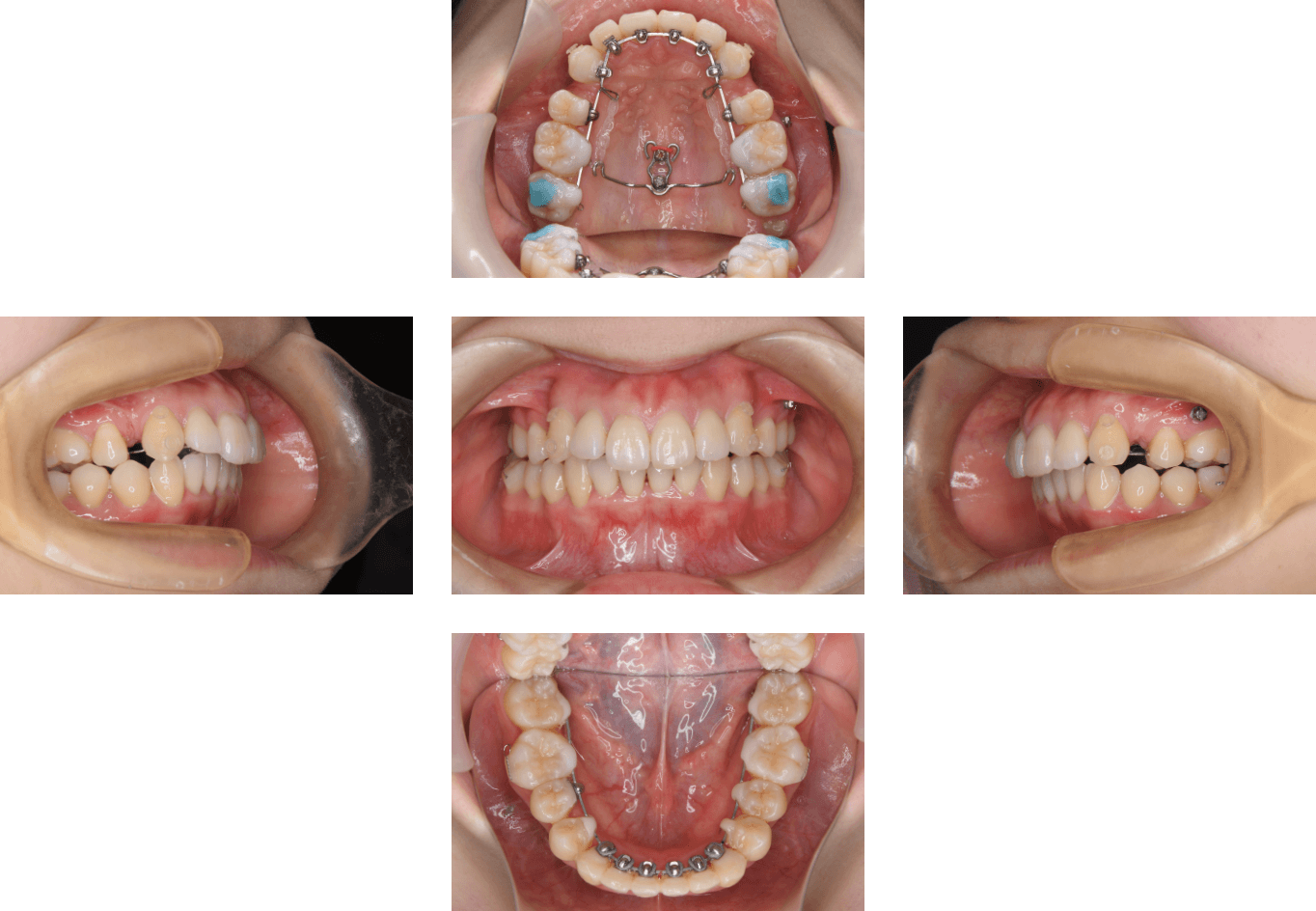 歯科矯正用アンカースクリュー| 福岡・天神のしもだ矯正歯科クリニック