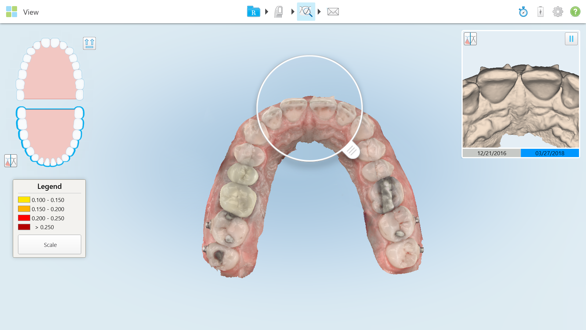 iTero element（口腔内スキャナー） | 歯科材料、歯科技工材料の通販