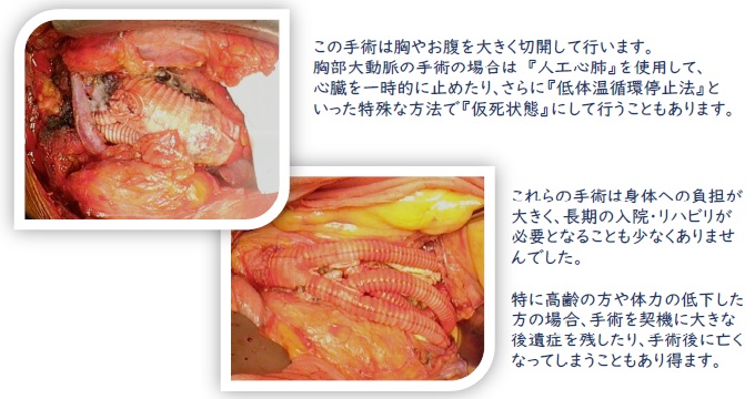 大動脈ステントグラフト内挿術：日立総合病院