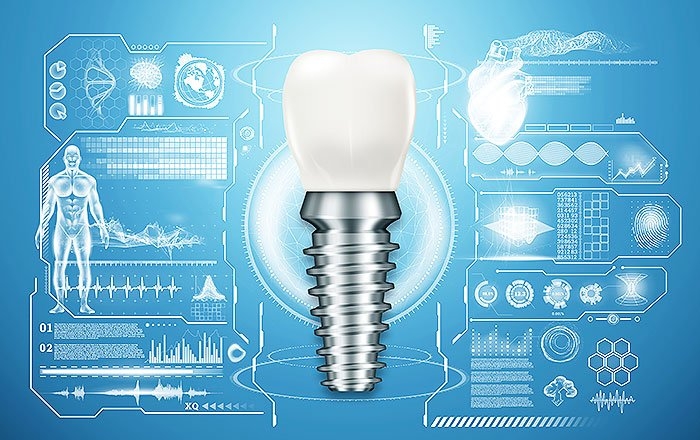 バイオインプラントについて～歯根膜再生を目指す次世代治療の研究と