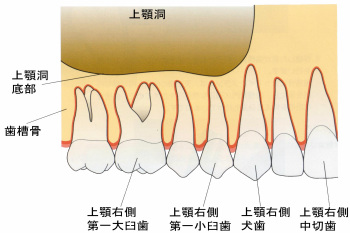 上顎洞挙上術（サイナスリフト） | インプラントネット