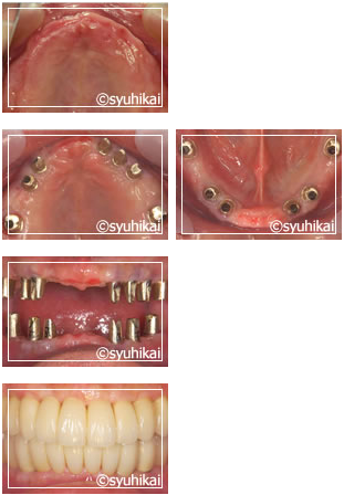 歯をすべて失った時のインプラント症例 | インプラントネット