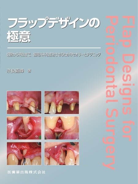 フラップデザインの極意 切除から再生まで，歯周外科を成功させるため