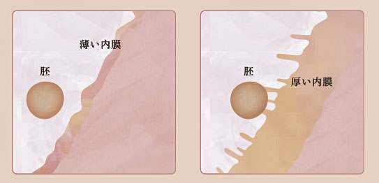 PFC-FD療法について - 静岡県沼津・三島 産婦人科・不妊治療の岩端医院