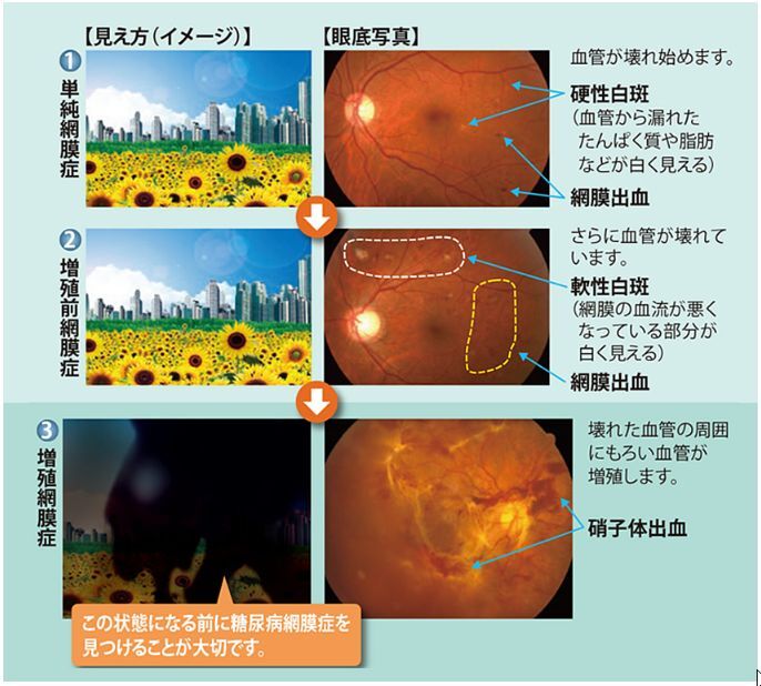 網膜治療 | 医療法人社団 沖本眼科 広島市東区光町 広島駅 眼科