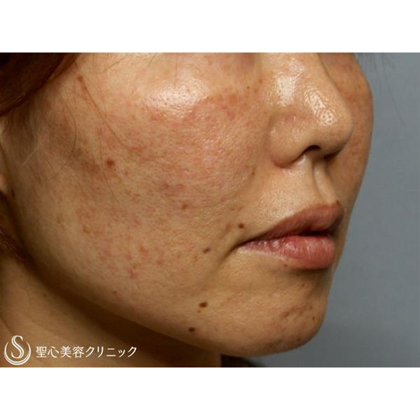 美容皮膚科「シミ・くすみ・毛穴」の症例写真｜聖心美容クリニック大阪院