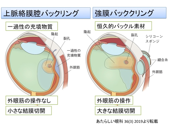 網膜硝子体・ぶどう膜 | 京都府立医科大学眼科学教室