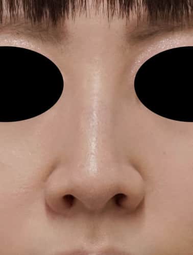 小鼻縮小（flap法） 1週間後