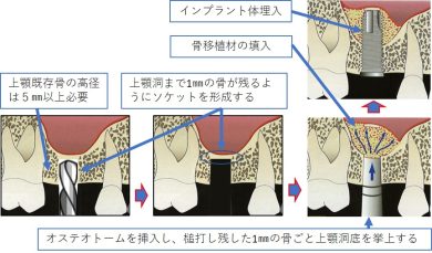 上顎のインプラント第二弾 上顎洞底挙上術について ｜ 森岡歯科医院