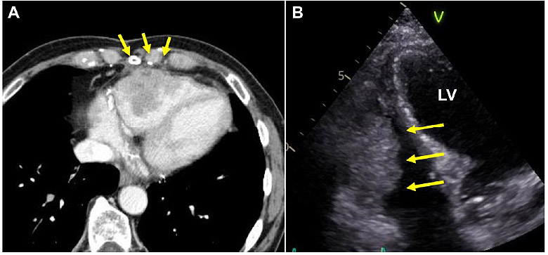 寺内泰観先生が血管内視鏡を用いた右室内腫瘍生検に関する論文を『JACC