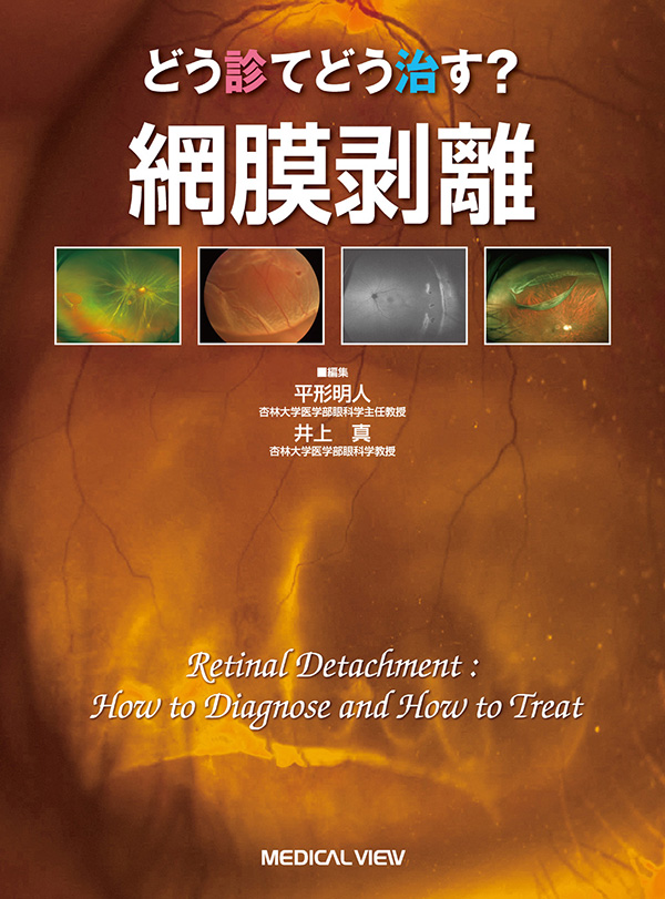 メジカルビュー社｜眼科｜どう診て どう治す? 網膜剥離
