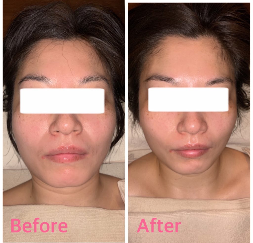 パーフェクトアクアリーボーテ2 EMS＊ビフォーアフター | Meshie銀座