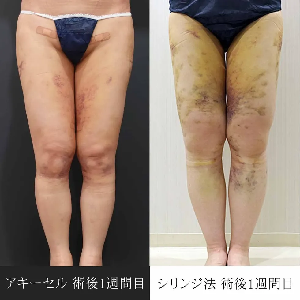 脂肪吸引 | 美容整形なら水の森美容クリニック【公式】