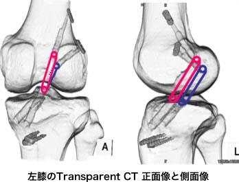 前十字靭帯再建術（ACL）