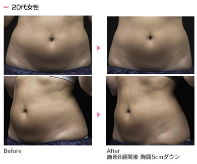 ライポソニックス（Liposonix）| ボディ・医療痩身｜北九州の美容外科
