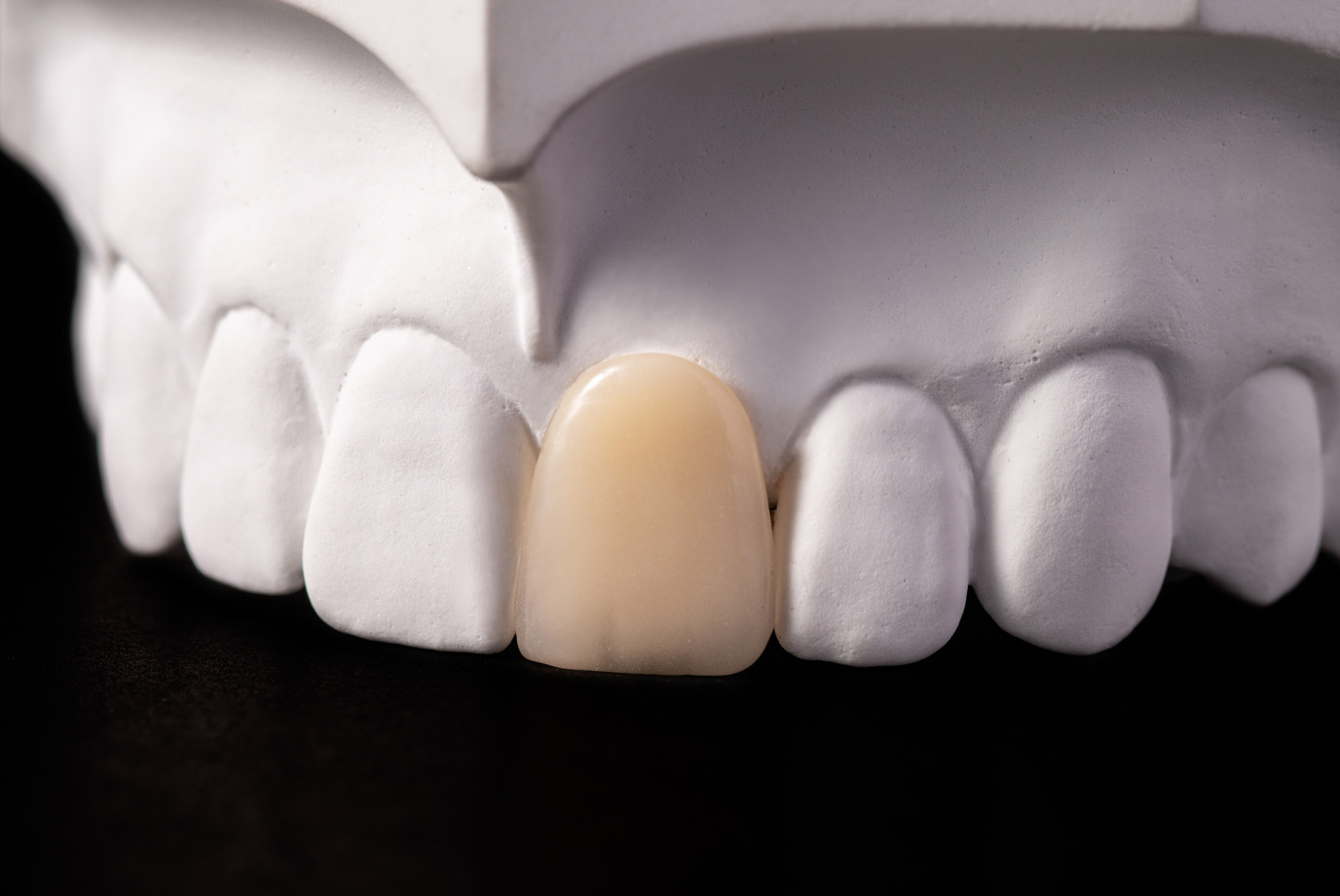 審美補綴物［MIブリッジ］｜株式会社シケン