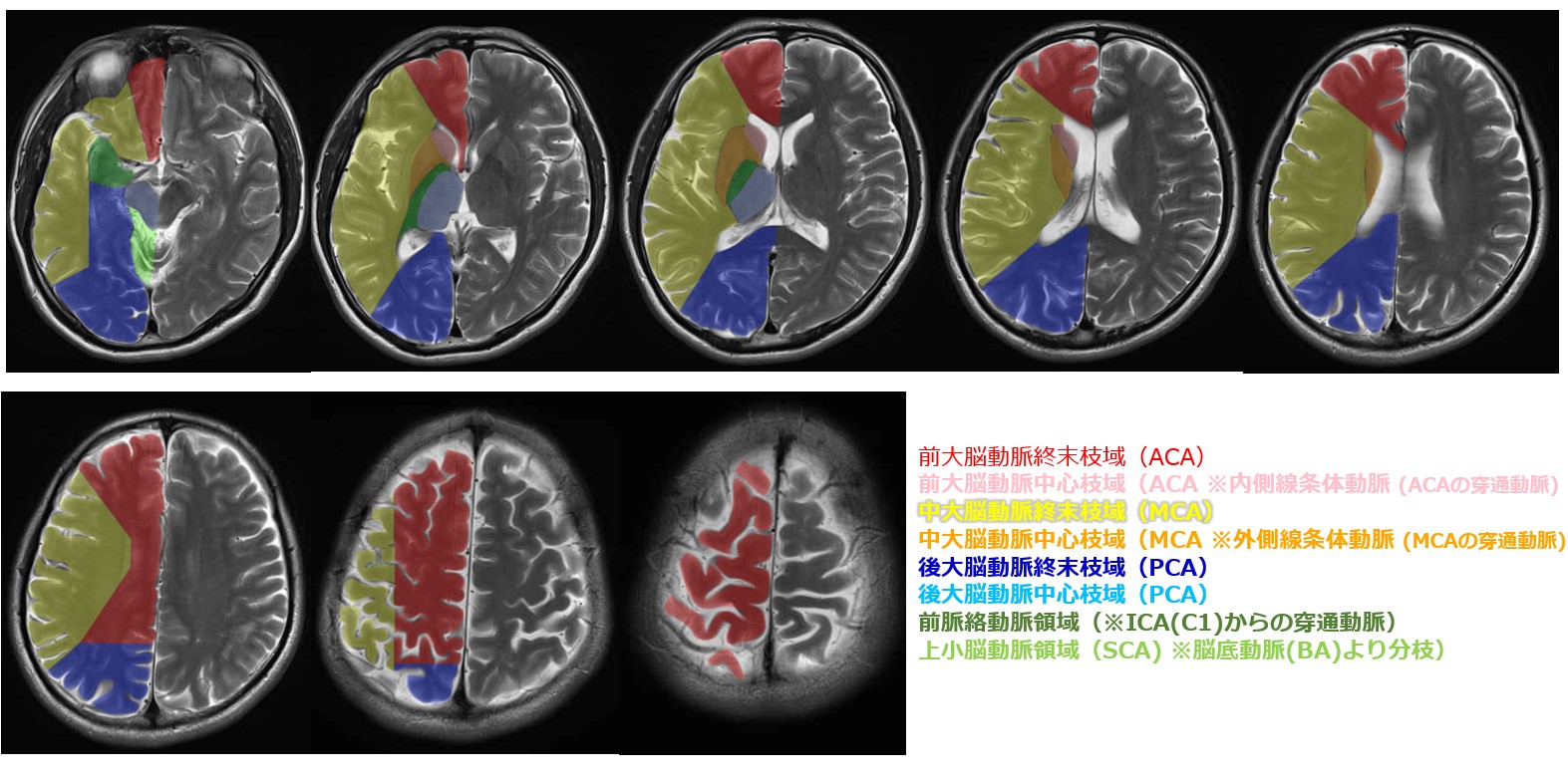 2022年最新】前頭葉の機能、MRI画像、遂行機能障害・注意・記憶・人格