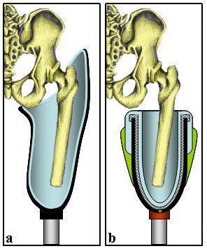 新しい大腿義足のソケット（NU-FlexSIV）の紹介！ | 田村義肢製作所