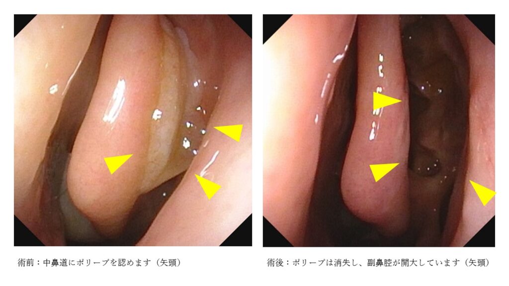 内視鏡下鼻副鼻腔手術 - 魚沼基幹病院