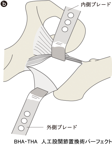 BHA・THA 人工股関節置換術パーフェクト〜人工骨頭置換術・人工股関節