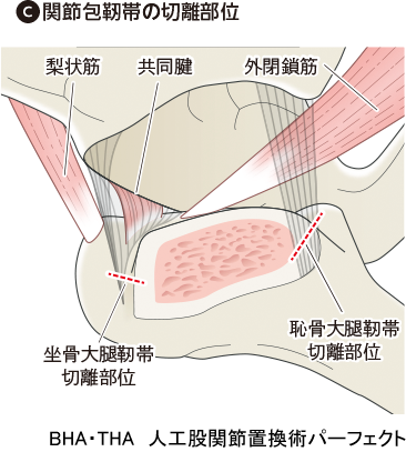 BHA・THA 人工股関節置換術パーフェクト〜人工骨頭置換術・人工股関節