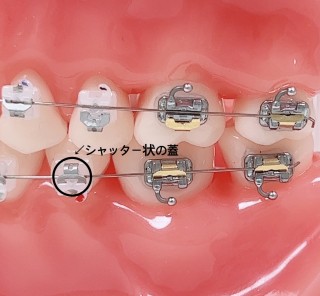 矯正は目立たない時代へ！当院の使用している装置について解説します