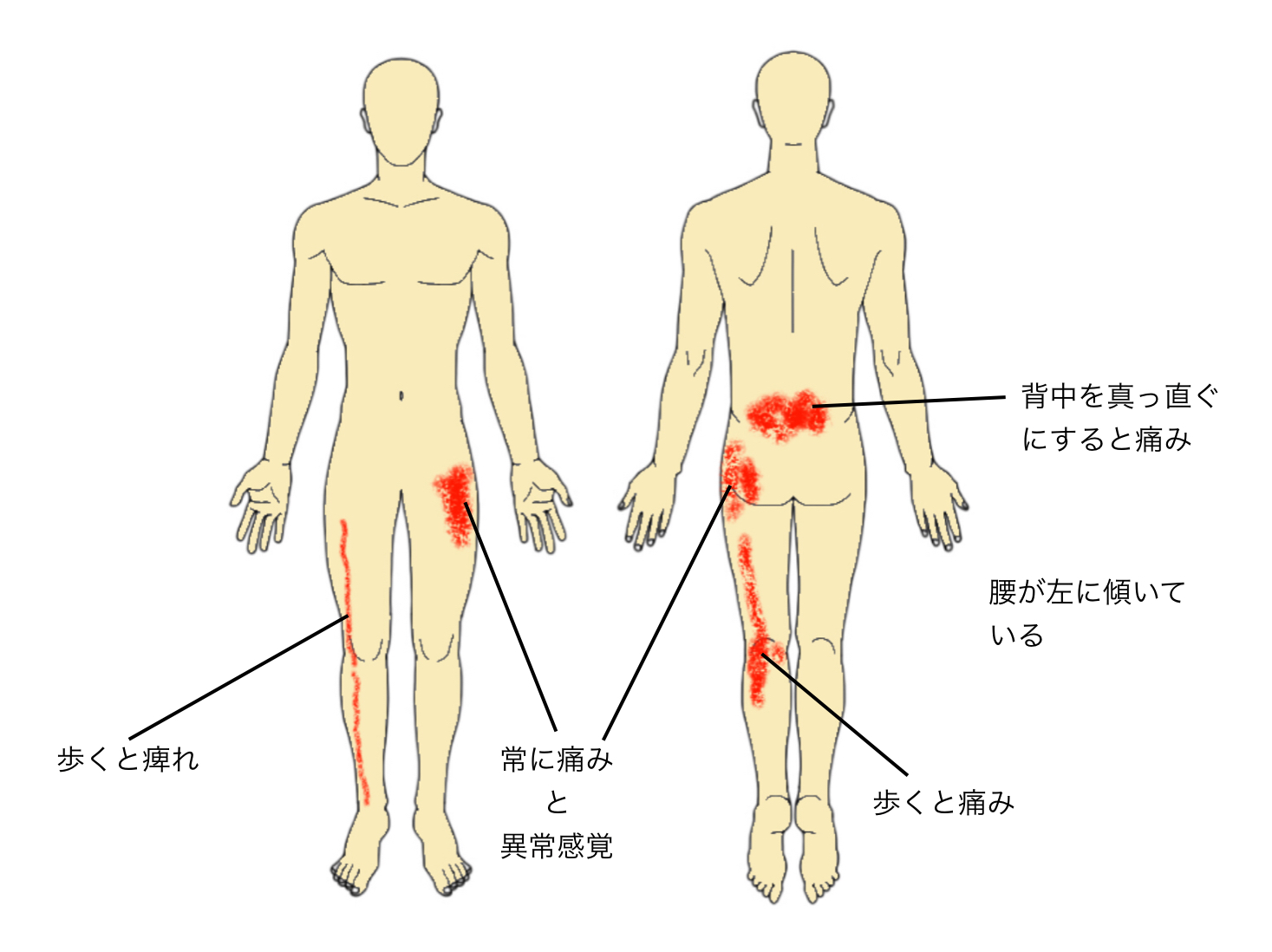 腰部脊柱管狭窄症手術記録 その 6（手術決断） | 医療法人博真会 横田