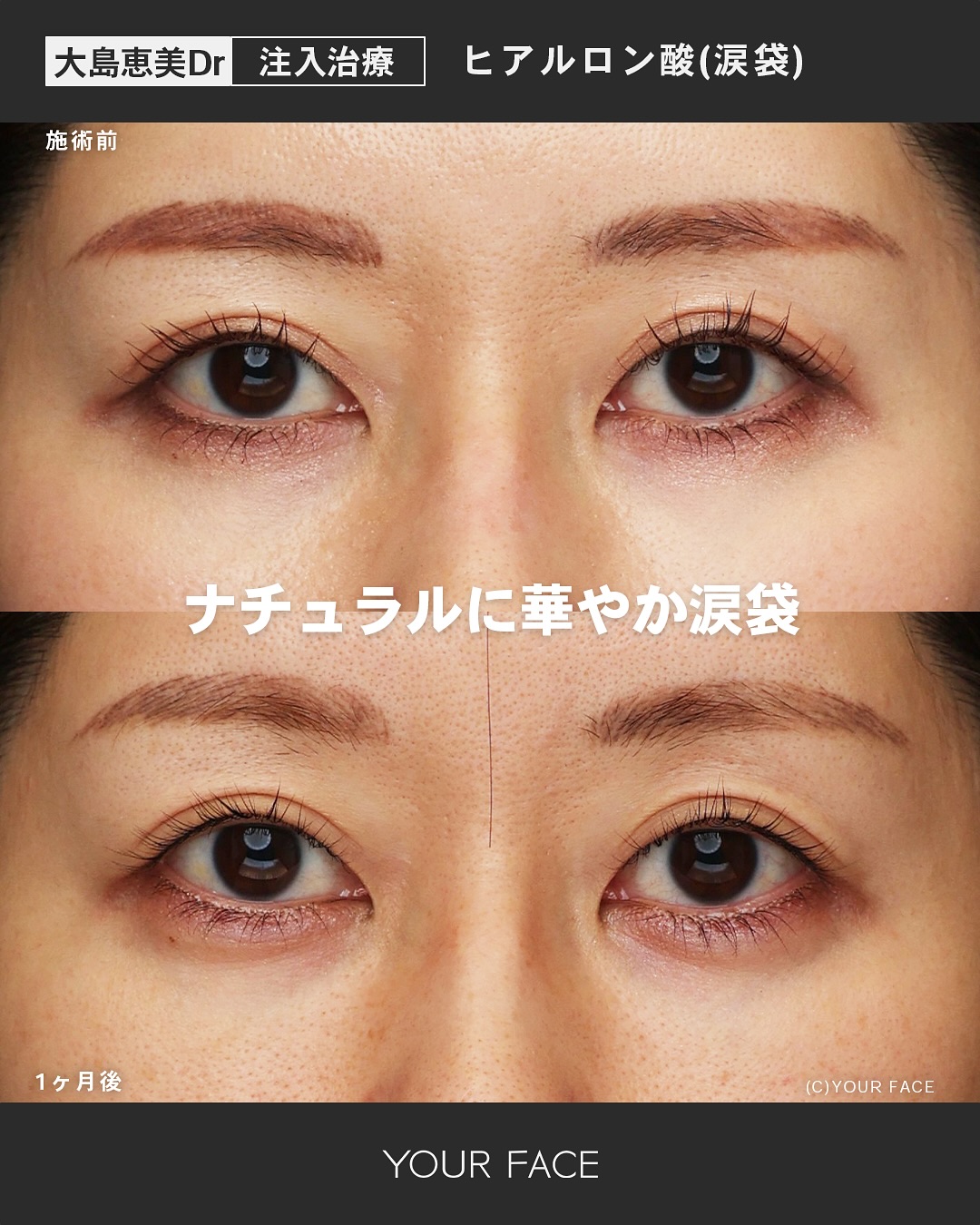 ヒアルロン酸 – YOUR FACE