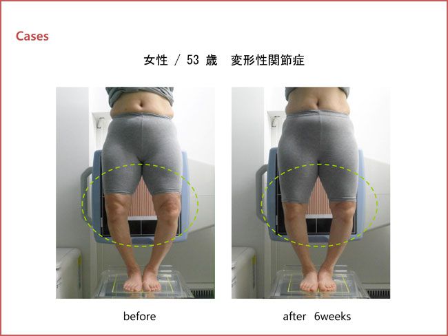 スタイレックス（O脚・X脚改善） | 姫路なかむら整骨院